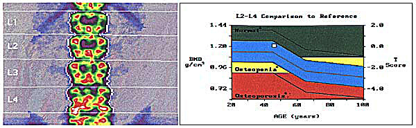 AP Spine by the DEXA Bone Densitometer