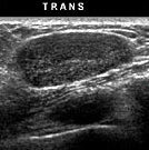 Ultrasound Examination of The Breast